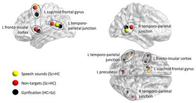 Imprecise Predictive Coding Is at the Core of Classical Schizophrenia